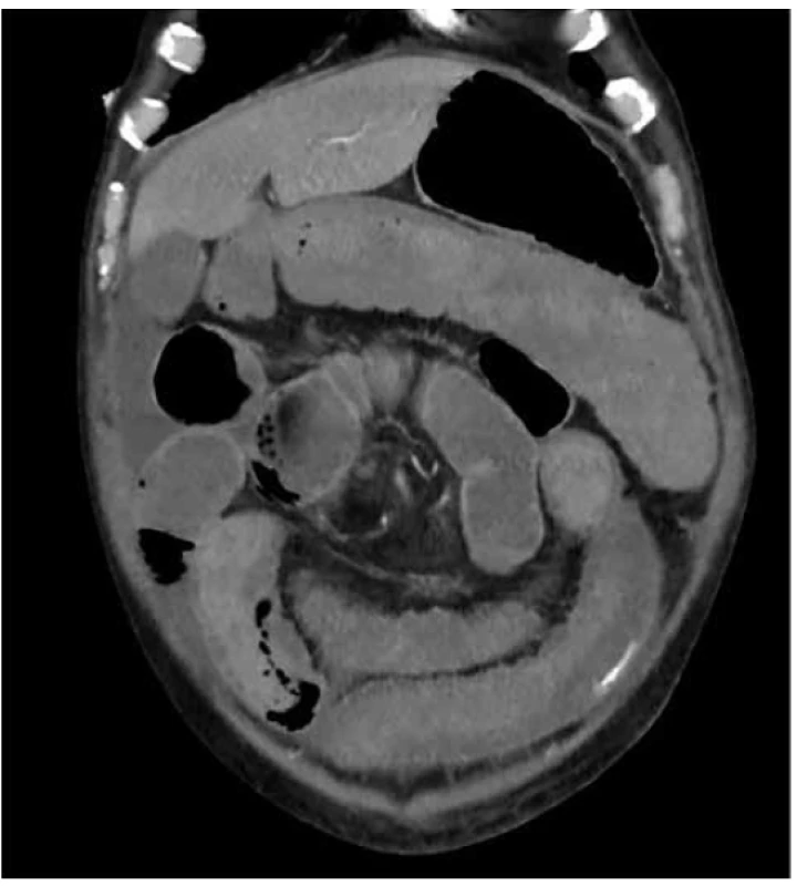 Aktivní zdroj krvácení v tenkém střevě v levém hypogastriu<br>
Fig. 5. Active bleeding from small intestinal wall in left
hypogastrium