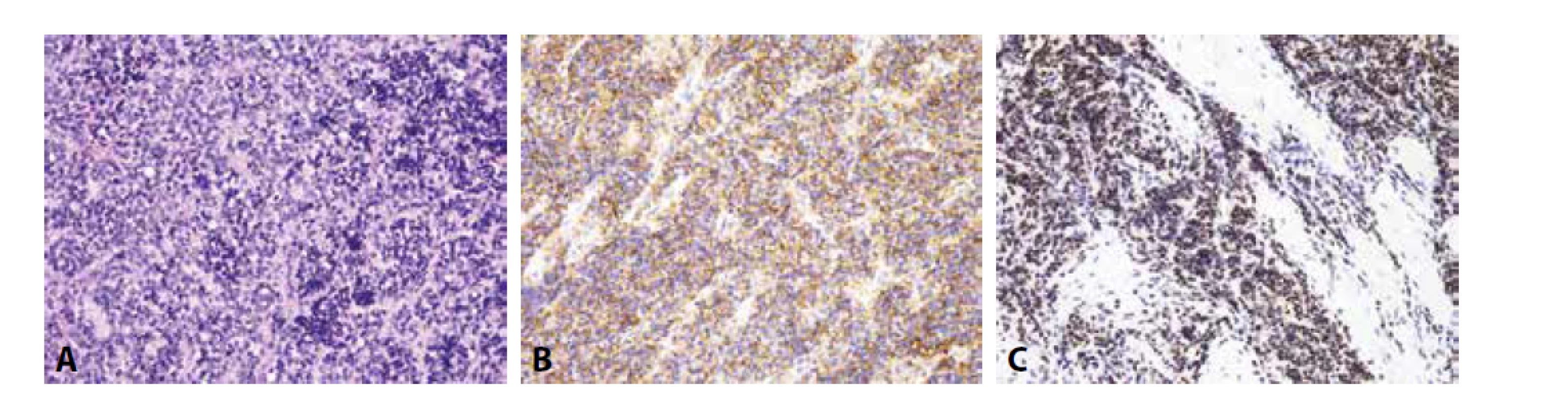 Ewingův sarkom. A) uniformní kulatobuněčný tumor (H&E); B) difúzní membránová exprese CD99; C) jaderná exprese Fli-1 (vše zvětšení
x200).