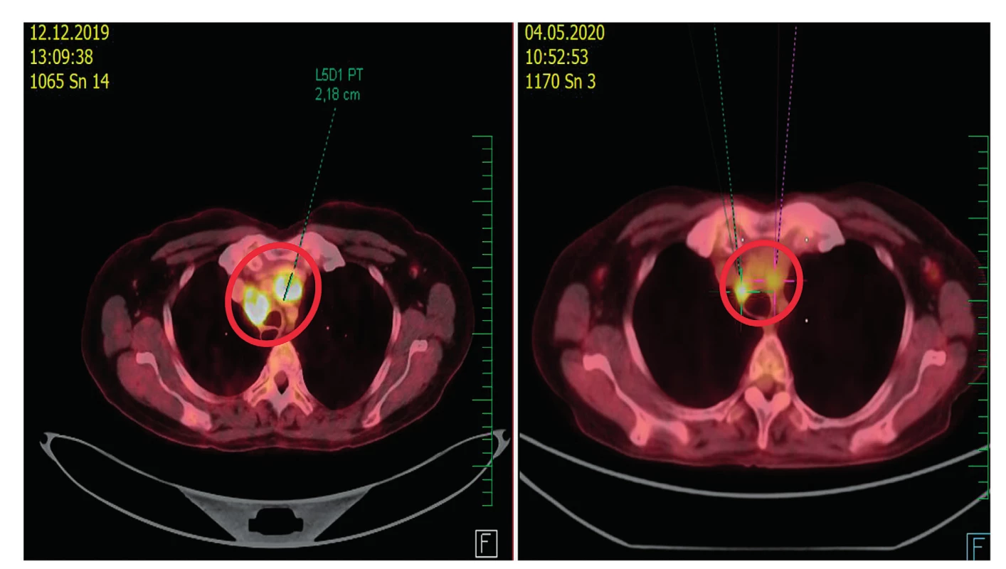 PET/CT. Částečná regrese metastatického postižení lymfatických uzlin
