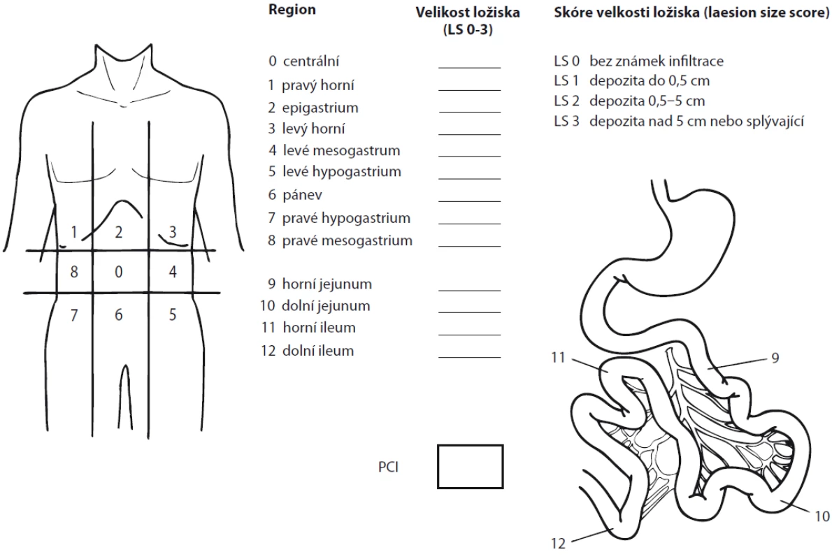 Peritoneal cancer index.