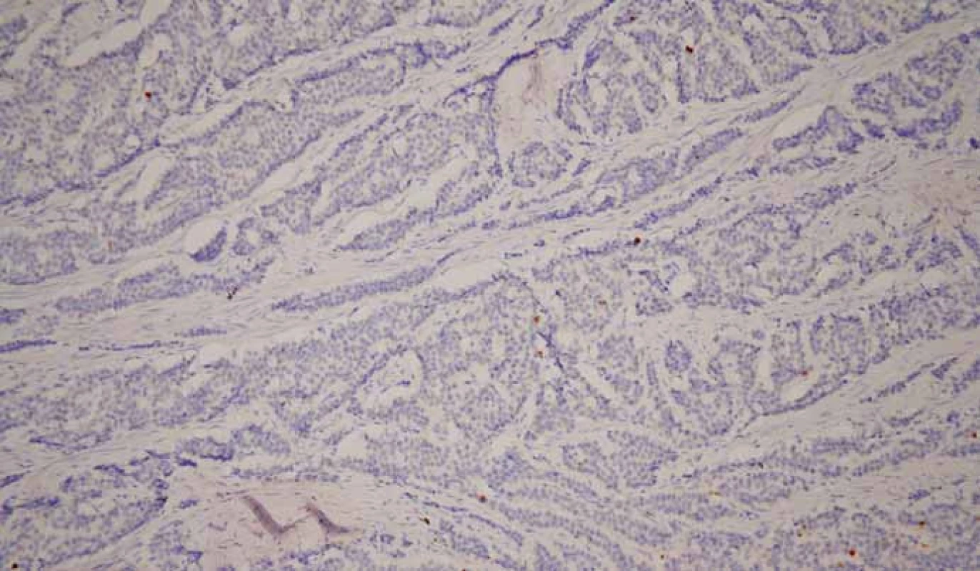 Neuroendokrinný nádor G1. Imunohistochemické vyšetrenie s protilátkou proti Ki-67. Ojedinelá pozitivita Ki-67 < 2 %. 3,3-diaminobenzidín, 200×.