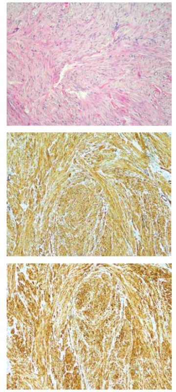 a-c. Histologický nález (a: hematoxylin-eozin, b: aktin,
c: desmin)