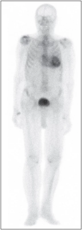 Celotělová scintigrafie skeletu s 99mTcDPD u pacienta s podezřením na srdeční
amyloidózu. Nález je pozitivní, odpovídá
stupni 3 podle Peruginiho. Akumulace radiofarmaka v myokardu je vyšší než akumulace
v žebrech, na celotělovém obrazu je patrné
zeslabení akumulace v dlouhých kostech.
Obr. 4 poskytnut a publikován s laskavým svolením doc. MUDr. Otto Langa, Ph.D., KNM 3.
LF UK a FNKV, Praha