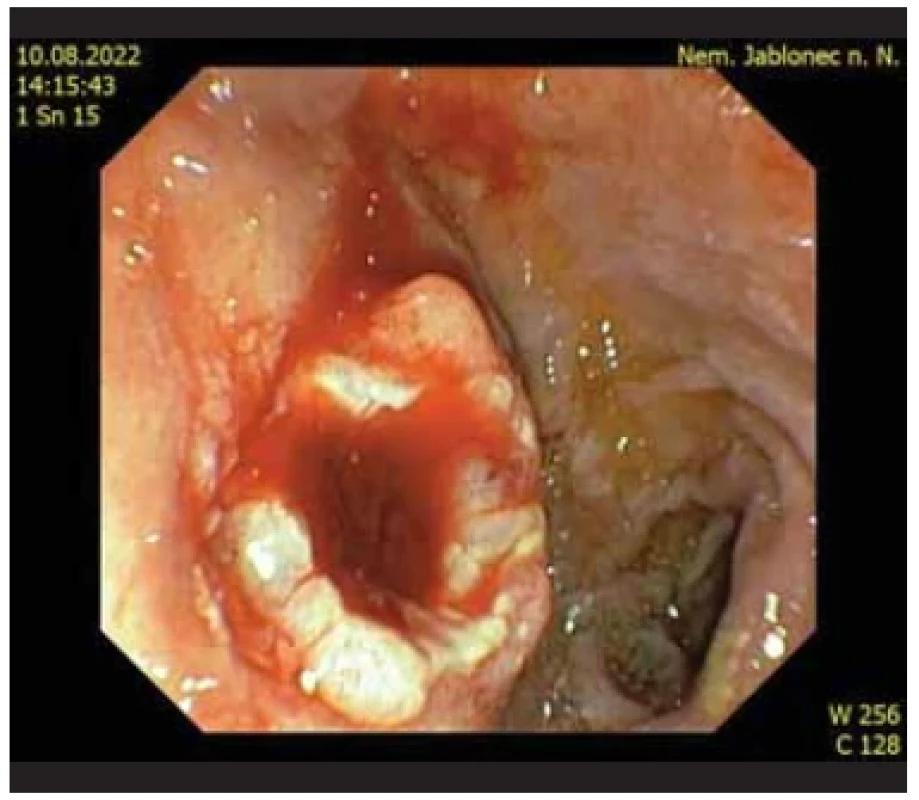 Granulace kolem stomického kanálu po extrakci LAMS. <br> 
Fig. 9. Granulation around the stomy canal after LAMS extraction.
