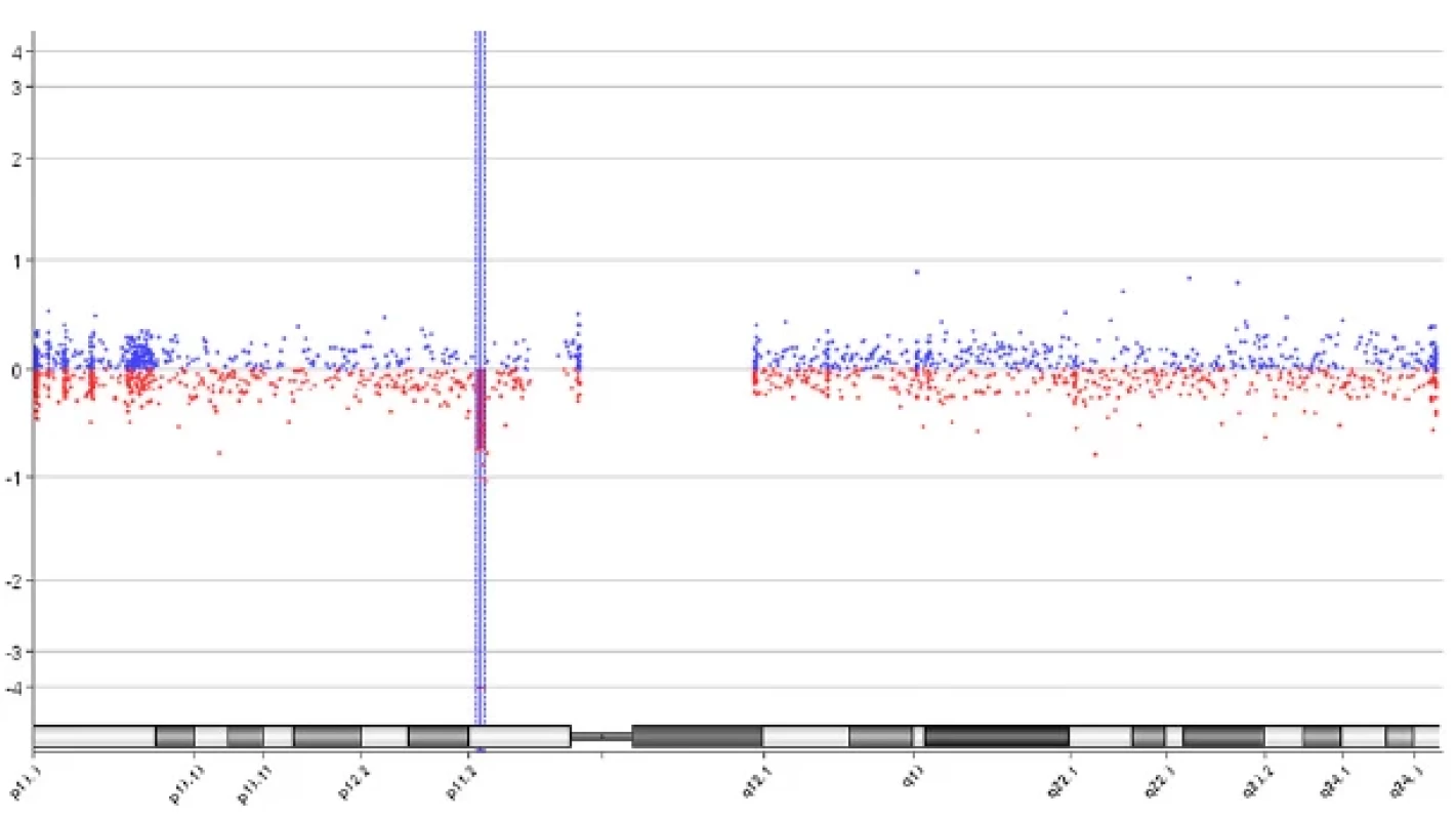Nález 678 kb 16p11.2 mikrodelece metodou array CGH: arr(GRCh37) 16p11.2(28503803_29182196)x1,
SurePrint G3 CGH ISCA v2 Microarray 8x60K, Agilent (deletovaná oblast je vyznačena modrým pruhem) <br> 
Fig. 2. Finding of 678 kb 16p11.2 microdeletion by array CGH: arr(GRCh37) 16p11.2(28503803_29182196)x1, Sure-
Print G3 CGH ISCA v2 Microarray 8x60K, Agilent (the deletion region is marked with a blue bar)
