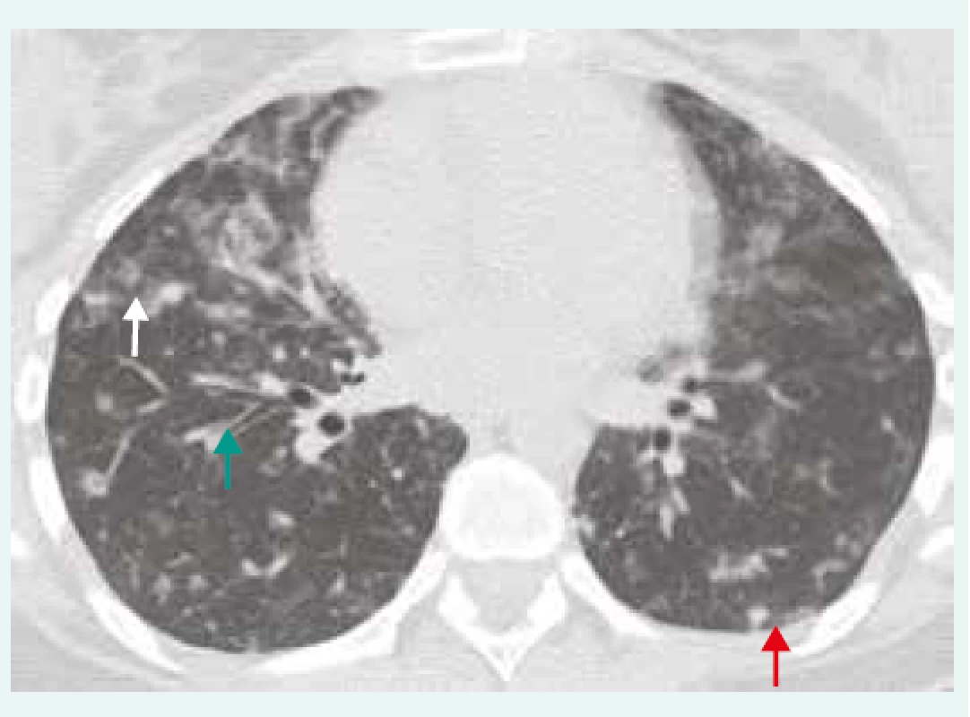 HRCT hrudníku u pacienta s GLID/CVID.<br>
Hraniční lymfadenopatie mediastinální a hilová,
nepravidelné centrilobulární opacity (bílá šipka),
nodularity zejména subpleurálně (červená
šipka), bronchiektázie/bronchioloektázie
(zelená šipka). IPP byla histologicky verifikována
jako GLILD/CVID. Z archivu autorky