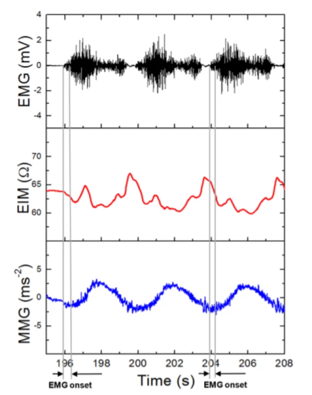  Detailed Holter EMG/EIM/MMG=f(t) signal
with EMG onset = 200 ms (isotonic 50% MVC).
