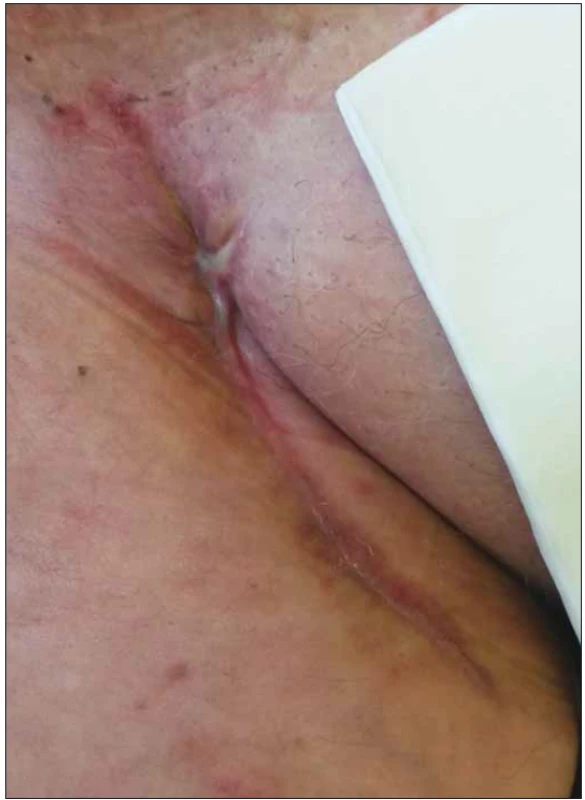 Stejná pacientka, zhojená rána po aplikaci podtlakové terapie
a preparátů vlhkého hojení.<br>
Fig. 2. Same patient, healed wound after negative pressure
wound therapy and moist wound healing application.