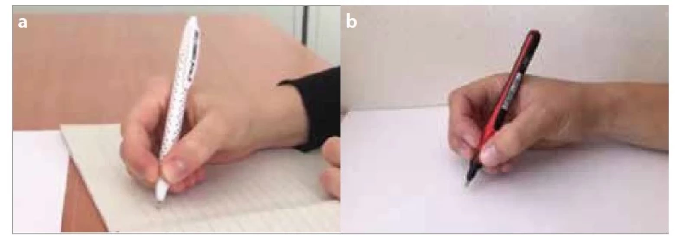 a,b. Otevřená špetka – a) vedená třemi prsty (tříprstá otevřená špetka),
b) vedená čtyřmi prsty (čtyřprstá otevřená špetka).<br>
Fig. 3a,b. Open web space grip – a) open web space tripod, b) open web space
quadruped grip.
