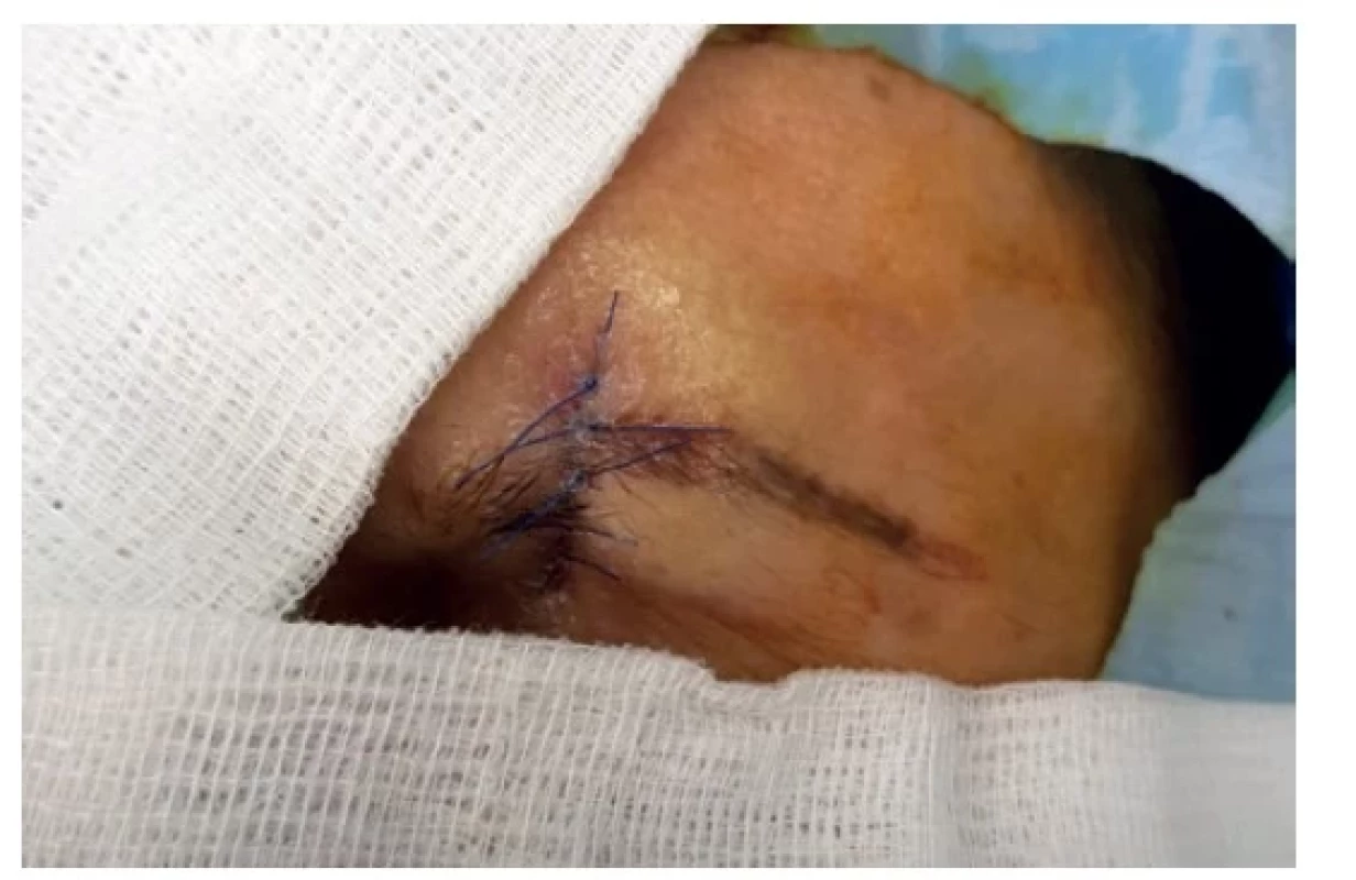 Stav po chirurgické korekci jizvy<br>
Fig. 3: Condition after surgical revision of the scar
