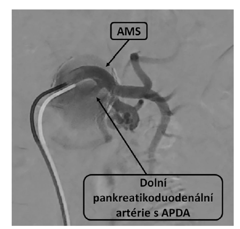 Angiografie, horní mezenterická tepna a dolní
pankreatikoduodenální tepna<br>
Fig. 2: Angiography, superior mesenteric artery and inferior
pancreaticoduodenal artery