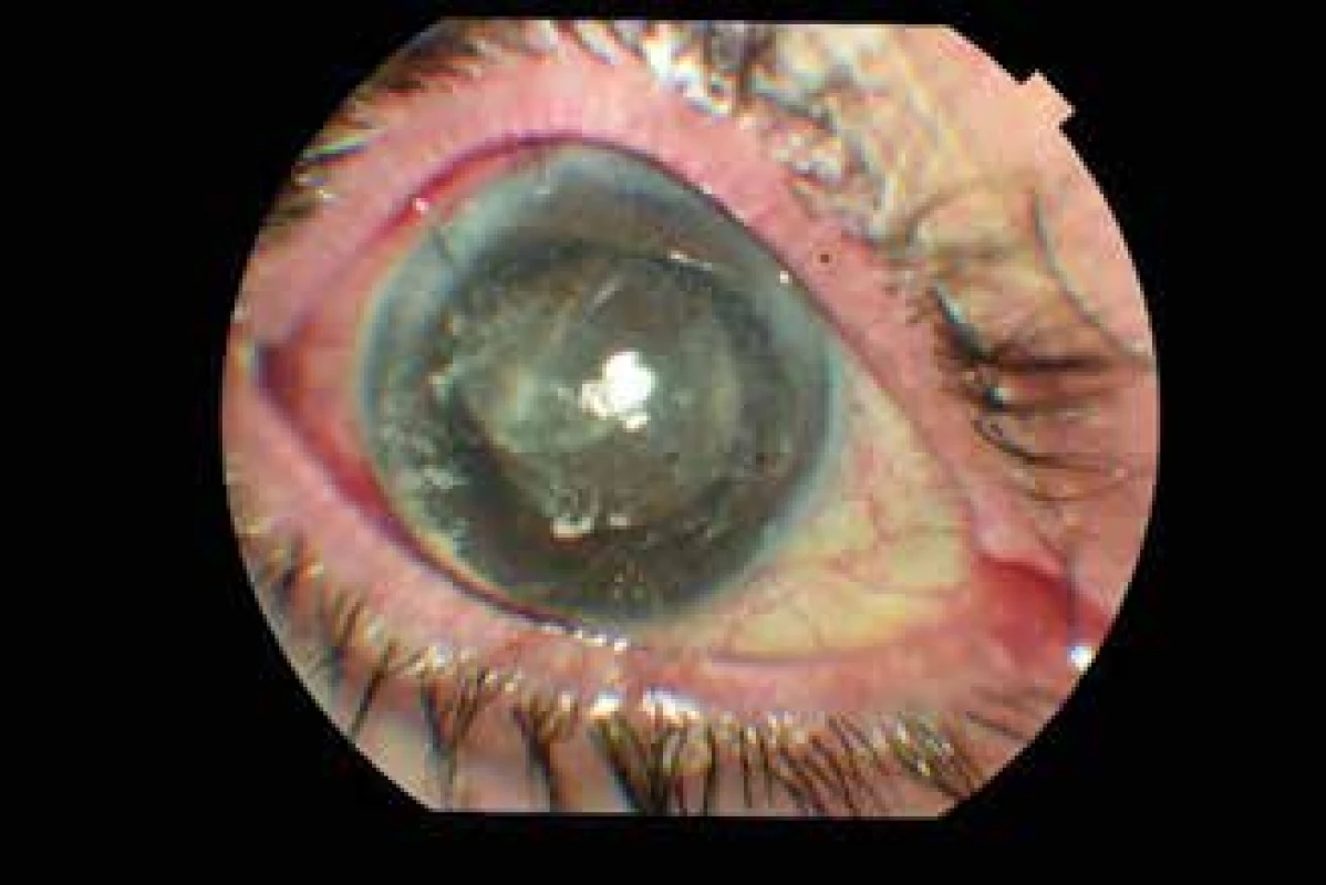 a. Image of anterior segment in patient 1 hour after
5-FU phacotrabeculectomy with intracameral injection
of triamcinolone acetonide (TA)