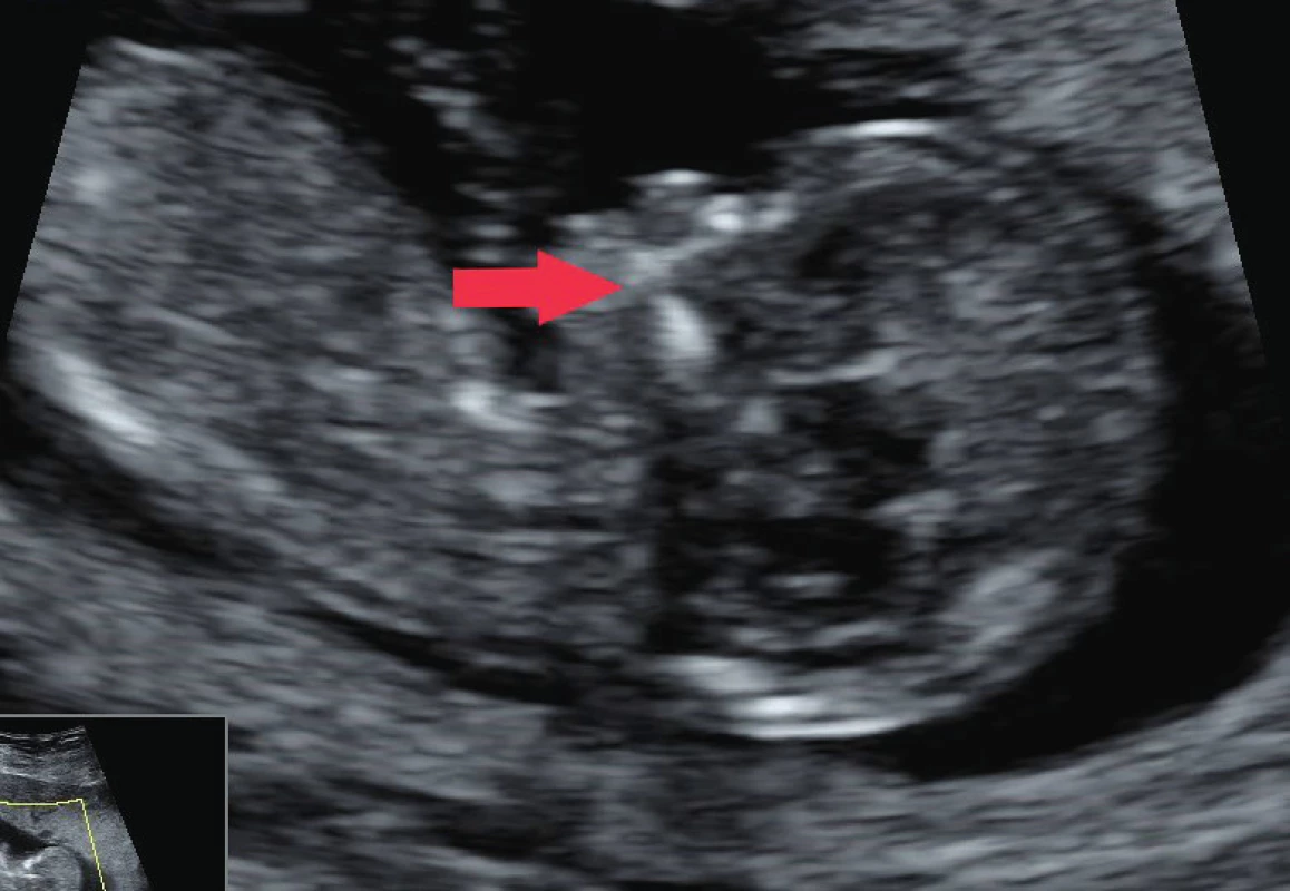 Mediosagitální řez v 1. trimestru; maxillary gap označen
šipkou