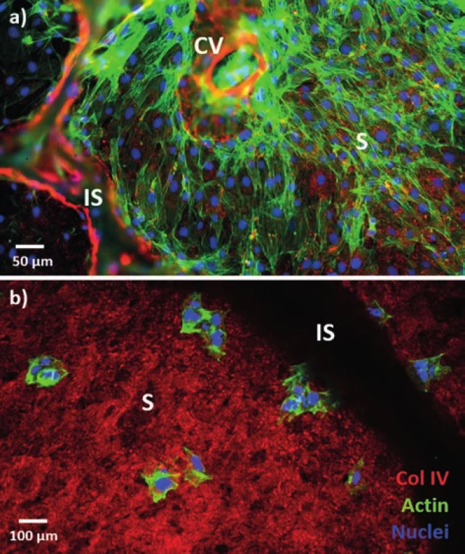 Fluorescenční obrázek buněk v decelularizovaném
skeletu prasečích jater
a) potkaní endotelové buňky po 7 dnech inkubace; b) buňky
linie HepG2 3h po aplikaci; zeleně je značen buněčný cytoskeleton,
červeně kolagen IV prasečího skeletu a modře buněčná
jádra. Oba typy buněk byly aplikovány metodou „drop
seeding“.<br>
Fig. 4: Fluorescence image of cells in the decellularized
pig liver scaff old
a) rat endothelial cells after 7 days of incubation; b) HepG2
cells 3h after seeding; the cytoskeleton is green, red is used
for collagen IV from the pig scaff old, and blue depicts the
nuclei. Drop seeding was used in both cases.
Vysvětlivky: S – sinusoidy, CV – centrální žíla, IS – interlobulární septum;
S – sinusoids, CV – central vein, IS – interlobular septum.