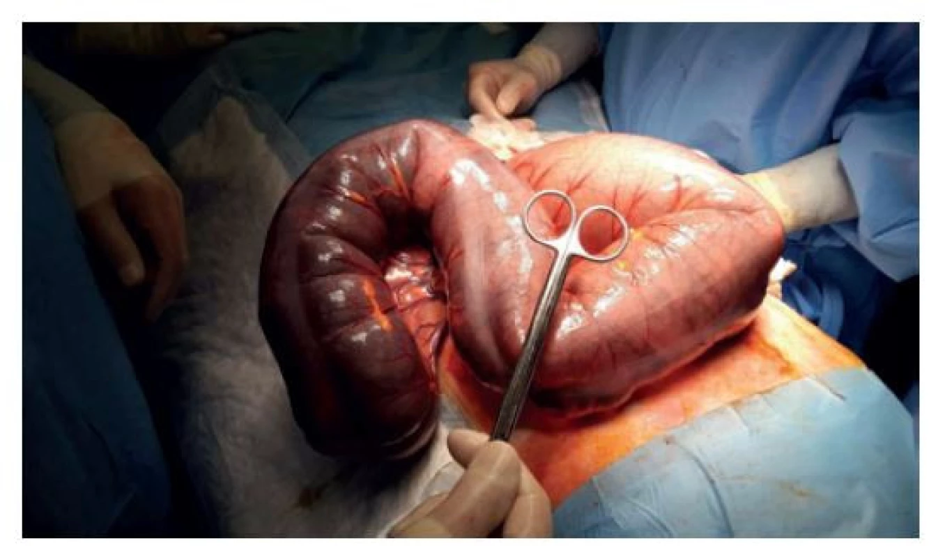 Peroperační nález<br>
Fig. 2: Perioperative finding