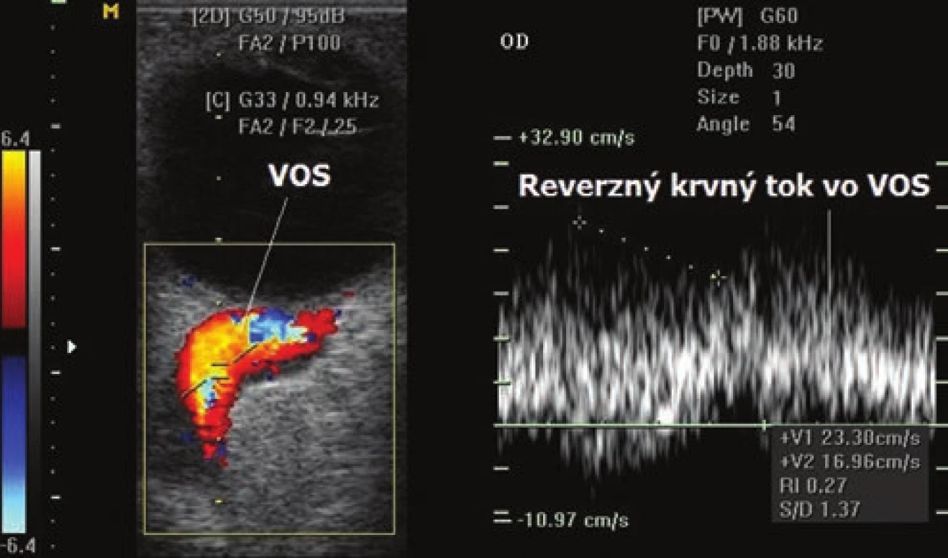  Farebné zobrazenie retrográdneho toku a dilatácie vena orbitalis superior (VOS) pri priamej karotído-kavernóznej fistule pomocou ultrasonografie Color Doppler.
Obrázok vľavo: Za fyziologických podmienok je venózny
krvný tok kódovaný modro a arteriálny červeno. V prípade
karotído-kavernóznej fistuly vzniká  retrográdny tok krvi,
to znamená zmena farebného kódovania z modrej na červenú. Vpravo: záznam spektrálnej analýzy retrográdneho
toku krvi vena orbitalis superior – reverzný krvný tok vo
VOS