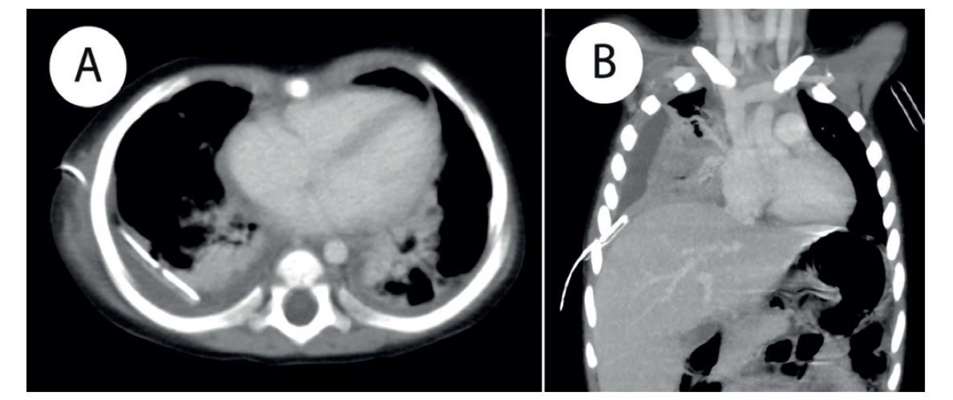 a) CT vyšetření po podání KL, tra rekonstrukce − pravostranná pleuropneumonie s pleurálním výpotkem a dorzálně
zavedeným hrudním drénem; b) CT vyšetření po podání KL, cor MIP rekonstrukce − pravostranná pleuropneumonie s pleurálním
výpotkem a zavedeným hrudním drénem.<br>
Fig. 2: a) Postcontrast CT examination, tra reconstruction − right sided pleuropneumonia with pleural effusion and chest
tube placed in the posterior pleural recess; b) postcontrast CT examination, cor MIP reconstruction − right sided pleuropneumonia
with pleural effusion; chest tube in place.
