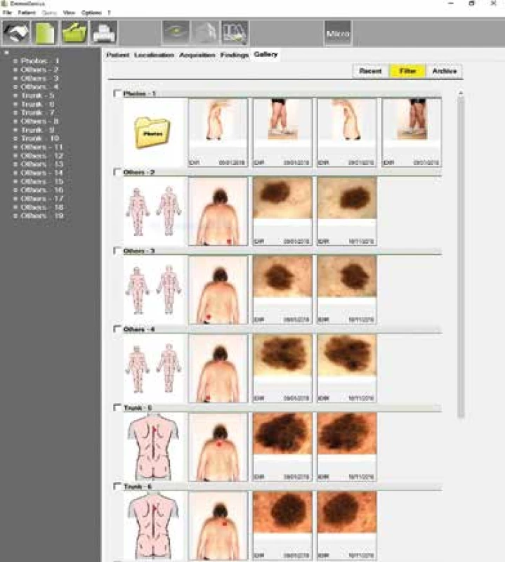 Digitální dermatoskopie vybraných lézí
v aplikaci DermoGenius