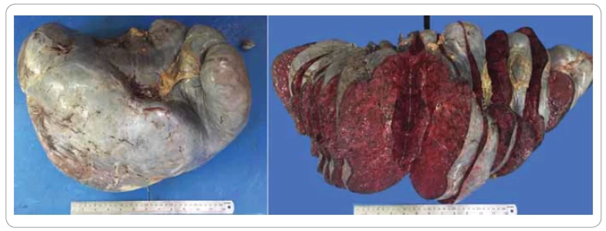 Gross appearance of the resected spleen.