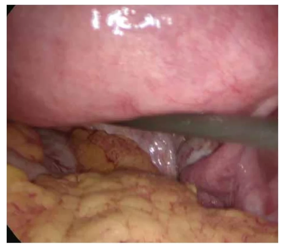 Nález z laparoskopie 5. 5. 2022 – pravá tuba bez evidentní dilatace.<br>
Fig. 2. Findings from laparoscopy May 5th, 2022 – the right salpinx with no obvious
dilation.