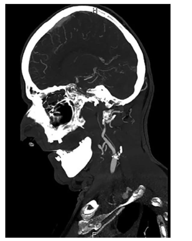 CT angiografie prokazující uzávěr levé ACI<br>
Fig. 1: CT angiography demonstrating occlusion of the
left ICA