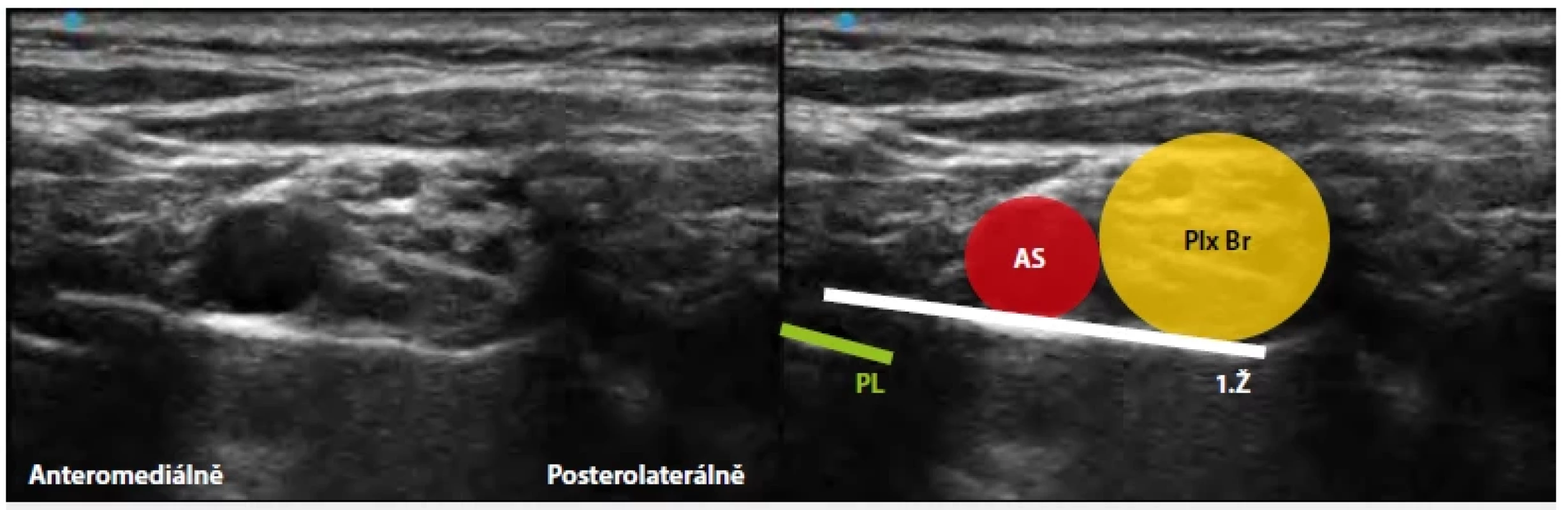 Supraklavikulární blokáda plexus brachialis