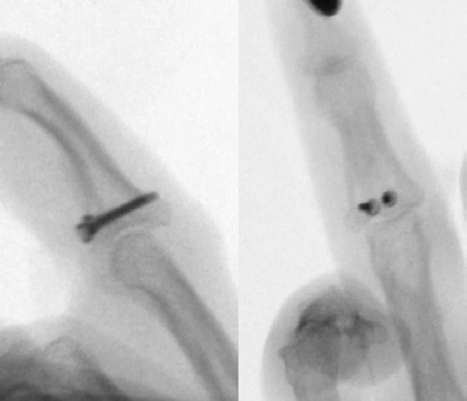 Peroperační RTG, při bližším pohledu je patrná nedokonalá repozice kloubní plochy