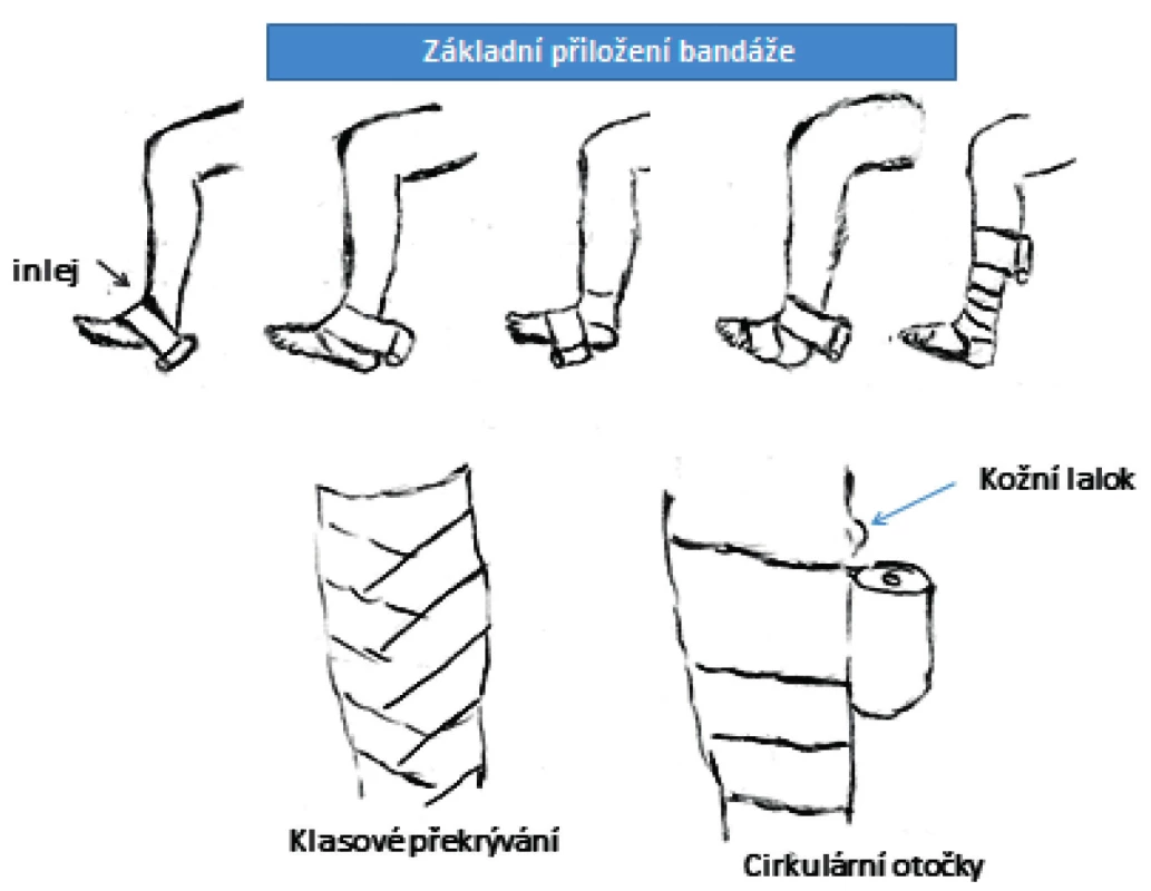 Schéma přikládání obvazů