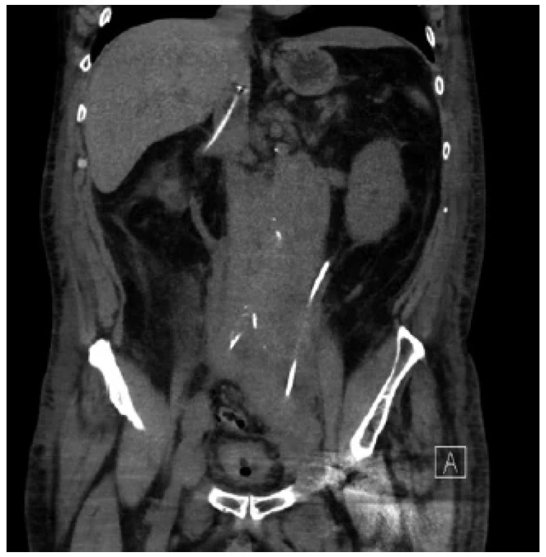 CT – vpravo zavedený PND s nafouklým
balonkem do VCI <br> 
Fig. 2. CT – the PNDT with an inflated balloon lodged
in the IVC on the right
