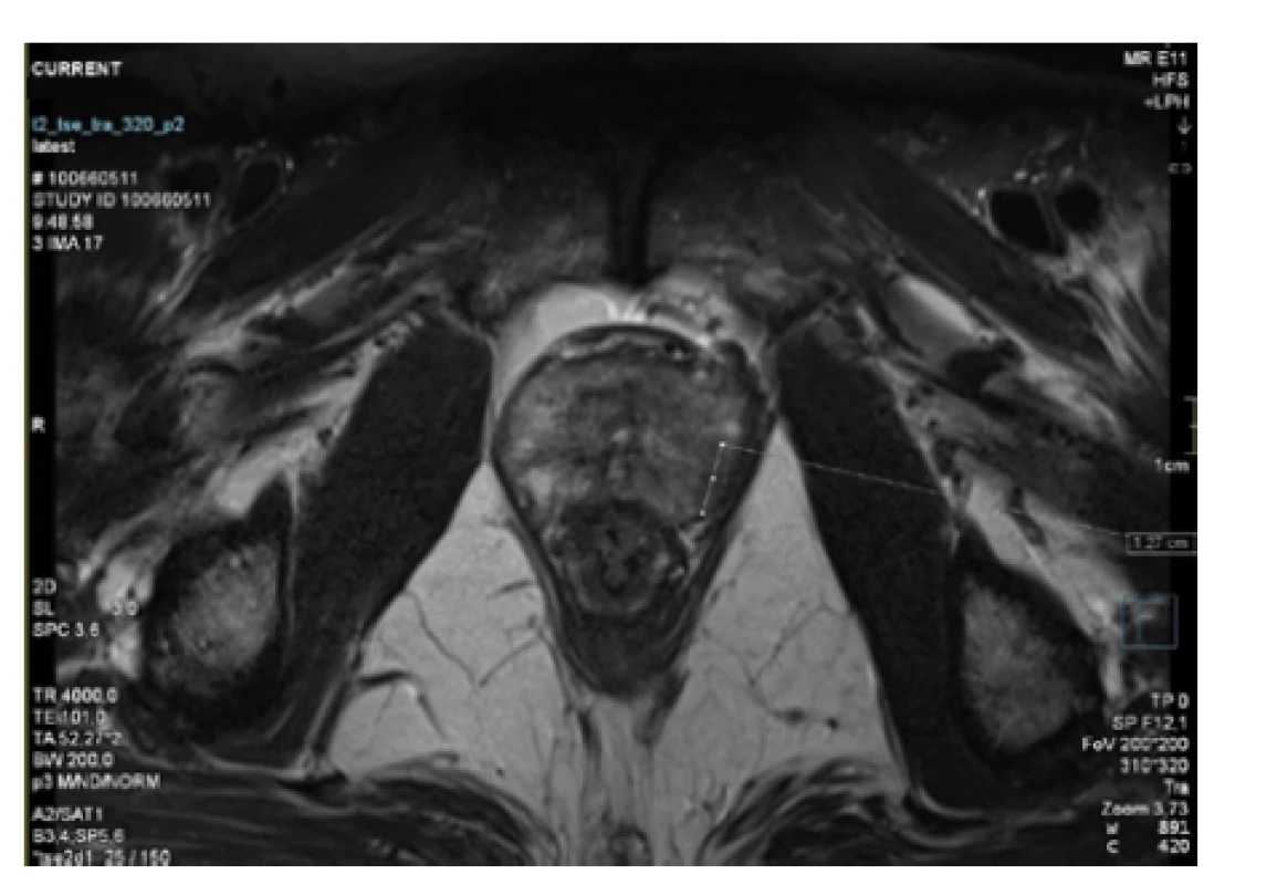 3T MRI prostaty s označeným ložiskem v levém
laloku<br>
Fig. 1. 3T MRI of the prostate with tumour in the left
lobe