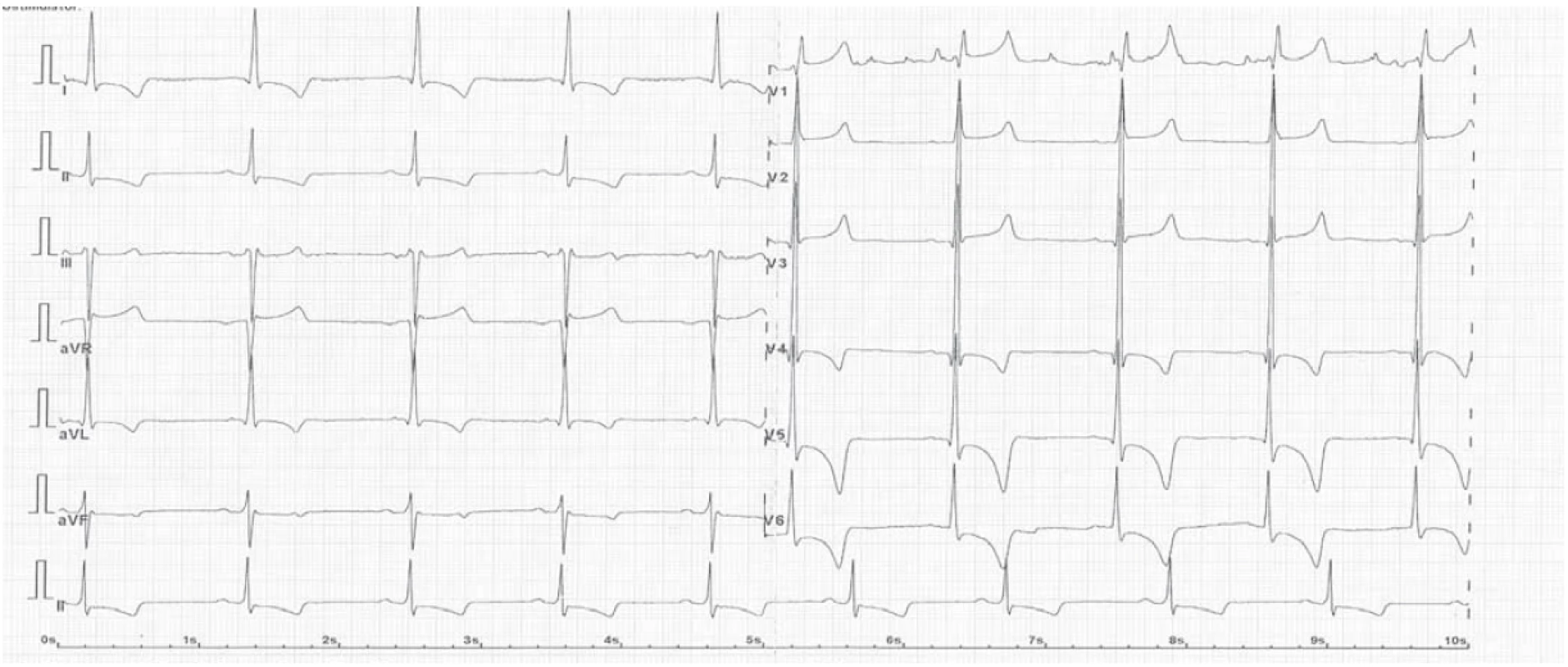 EKG křivka u pacienta s Anderson-Fabryho chorobou – nález hypertrofické kardiomyopatie, zkráceného PQ intervalu
< 120 ms, známky hypertrofie a zatížení levé komory (voltáž QRS komplexů a změny ST úseků).<br>
Fig. 2. ECG curve in an Anderson-Fabry disease patient with hypertrophic cardiomyopathy, shortened PQ interval < 120 ms,
signs of hypertrophy and left ventricular load (QRS complex voltage and changes in ST segments).