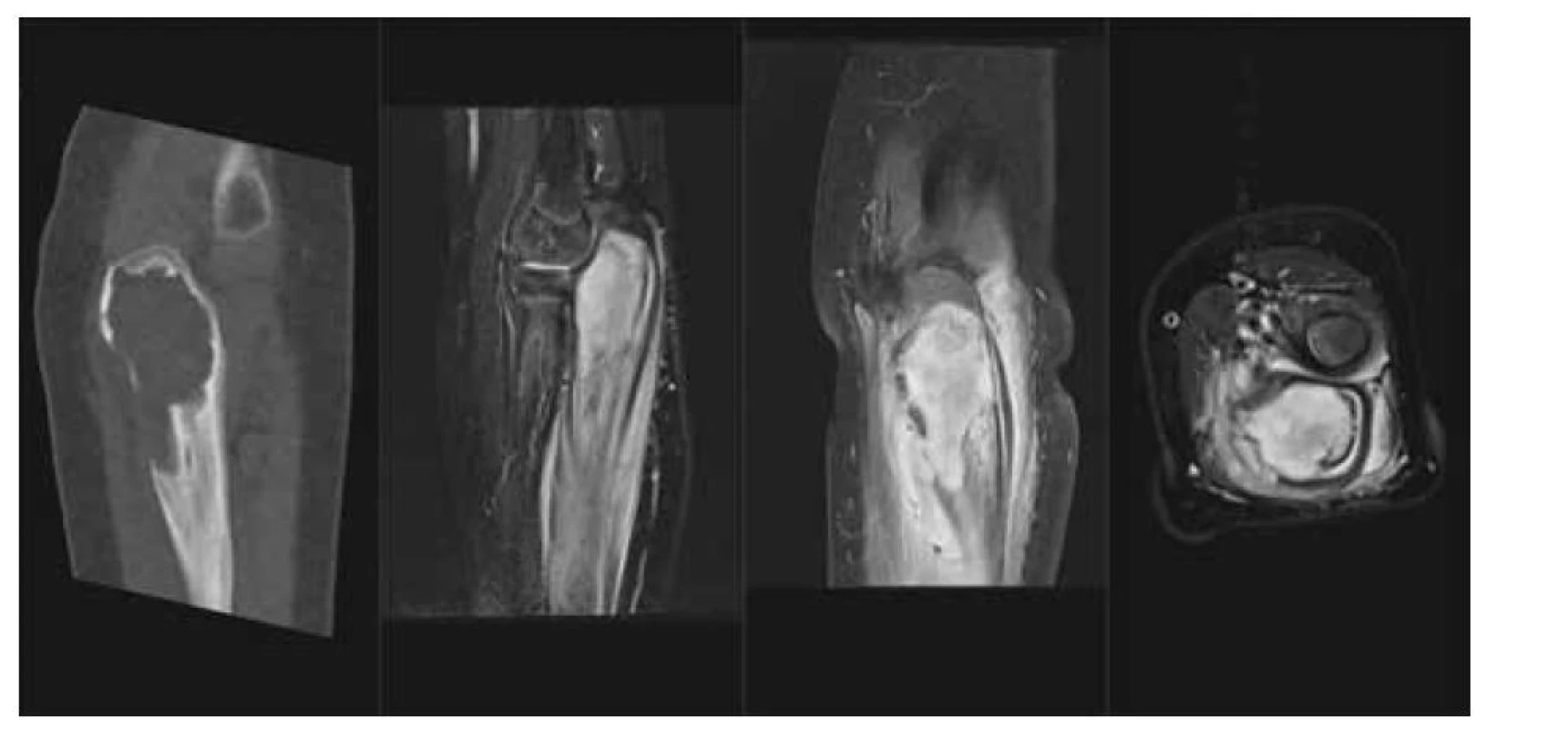 LCH – kostní tumor: a) CT scan v kostním okně, nativně, osteolytické ložisko proximální ulny
a olecranu, b) MR T2 STIR scan v sagitálním řezu, solidní infiltrace kostní dřeně proximální ulny, periostální
reakce, c) MR T1 scan s potlačením tuku v sagitální rovině, tumor kosti, extraoseální šíření
a periostální reakce, d) MR T1 s potlačením tuku v axiální rovině, tumor proximální ulny s extraoseální
propagací.<br>
Fig. 2. LCH – tumor of proximal ulna: a) lytic lesion on CT scan, b) soft tissue tumor, edema and periostosis
of the ulna on MR STIR scan, c) enhancing tumor with extraosseoal spred on T1 fs in sagital plane and d)
in axial plane.