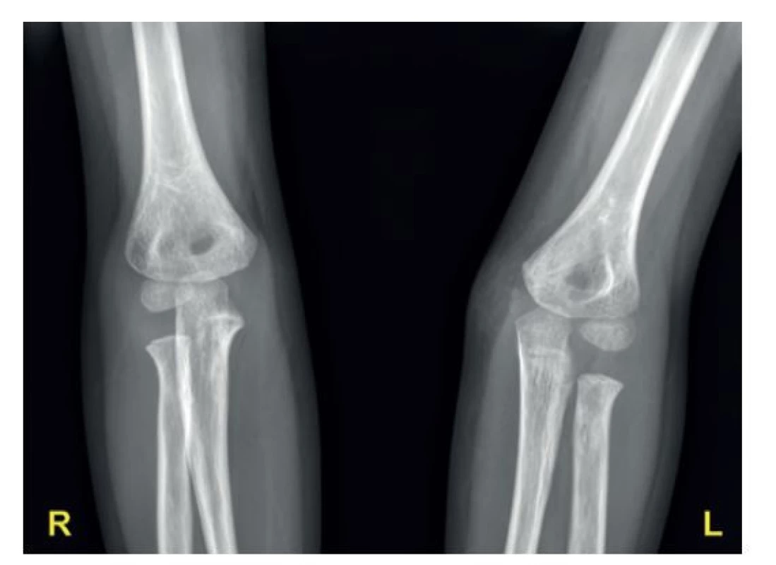 Kontrolní snímek po extrakci kovů (včetně srovnávacího
snímku zdravého lokte) s patrnou počínající osifikací
mediálního epikondylu levého humeru v anatomickém
postavení<br>
Fig. 6: Follow-up plain X-ray after implant removal (including
comparison with the uninjured elbow) with incipient
ossification of the medial epicondyle of the left humerus
in its anatomical position