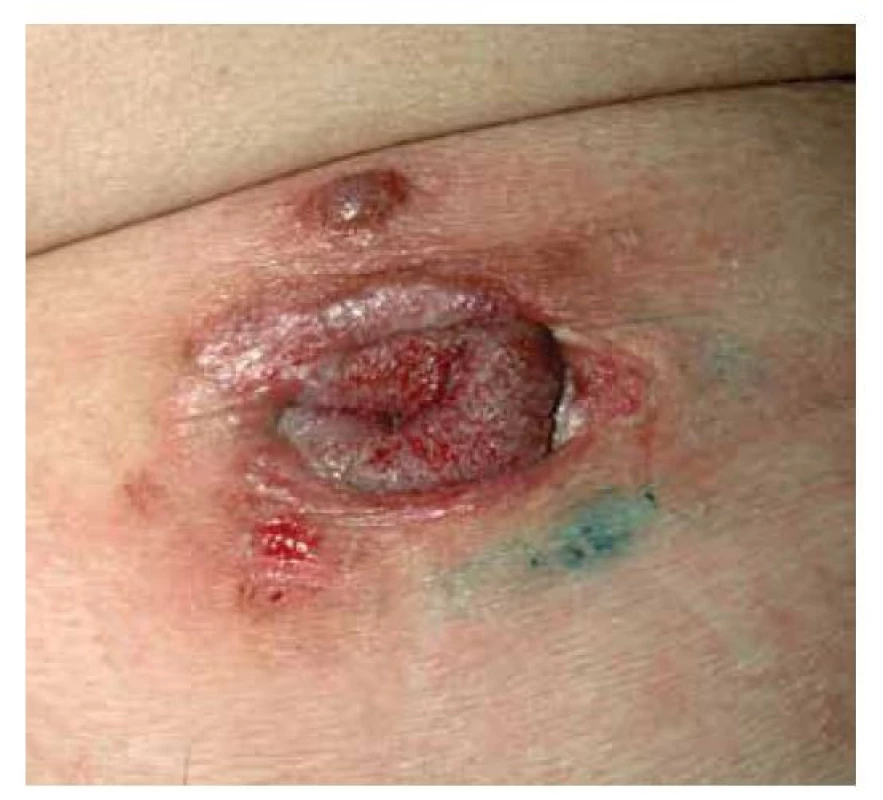 Pemphigus vegetans, typ Neumann