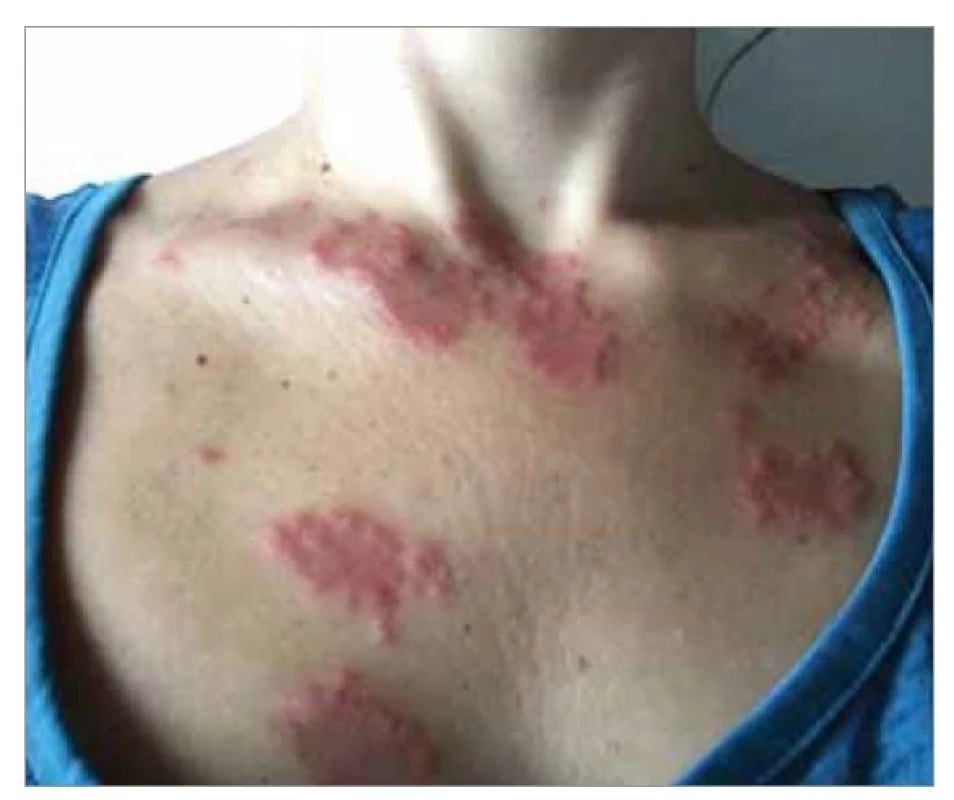 Kožní léze – Sweetův syndrom.<br>
Fig. 1. Skin lesions – Sweet’s syndrome.