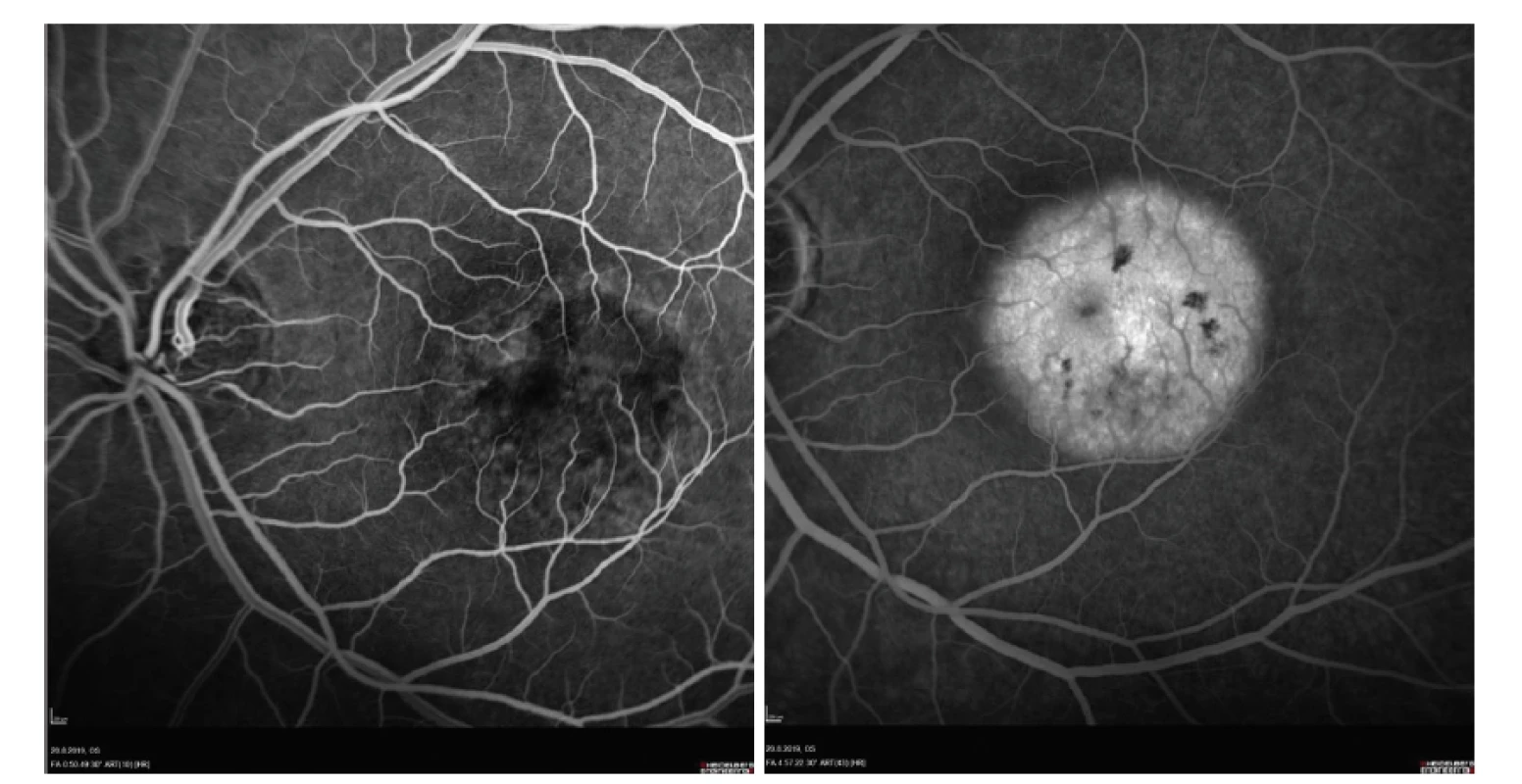 Časná (A) a pozdní fáze (B) fluorescenční angiografie pacienta s chorioretinitidou