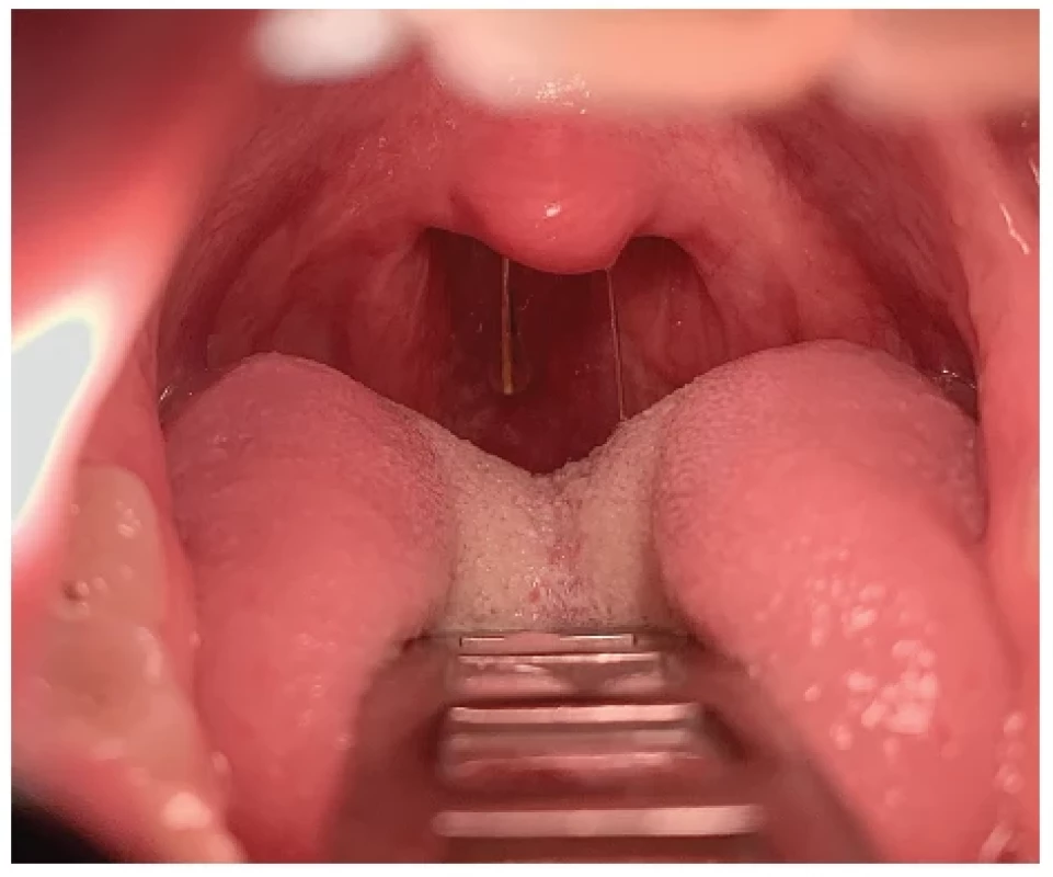 Zavedená Restech sonda
do úrovně měkkého patra  <br> 
Fig. 2.
Restech probe introduced to
the level of the soft palate