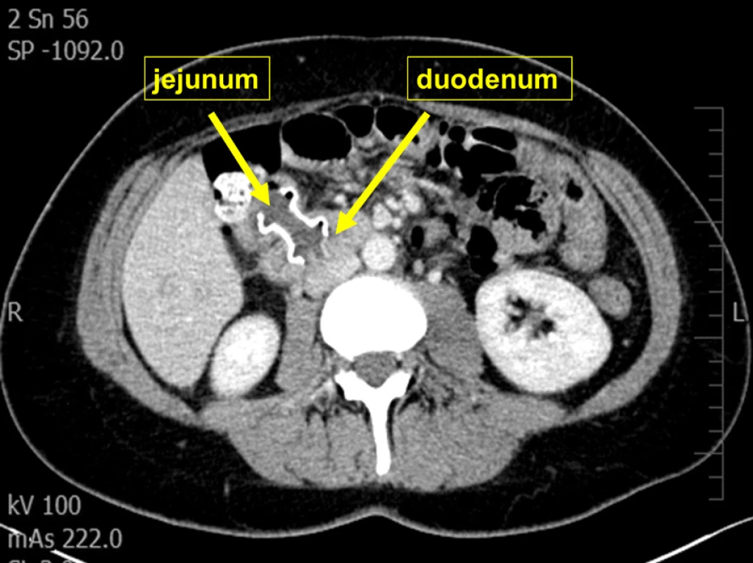 CT snímek jejunoduodenostomie <br>
Fig. 5: CT scan of jejunoduodenostomy