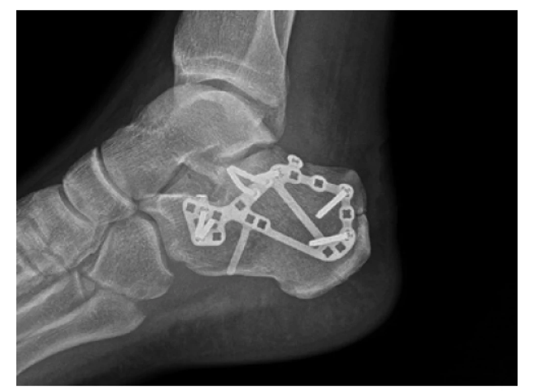 Rentgenový snímek dlahové osteosyntézy VA-CLP
dlahou (DePuy Synthes) umožňující širokou škálu možností
osazení šrouby s variabilním úhlem zavedení<br>
Fig. 6: Postoperative X-ray of osteosynthesis using VA-CLP
plate (DePuy Synthes) offering a wide variety of screw
combinations and variable angle of insertion