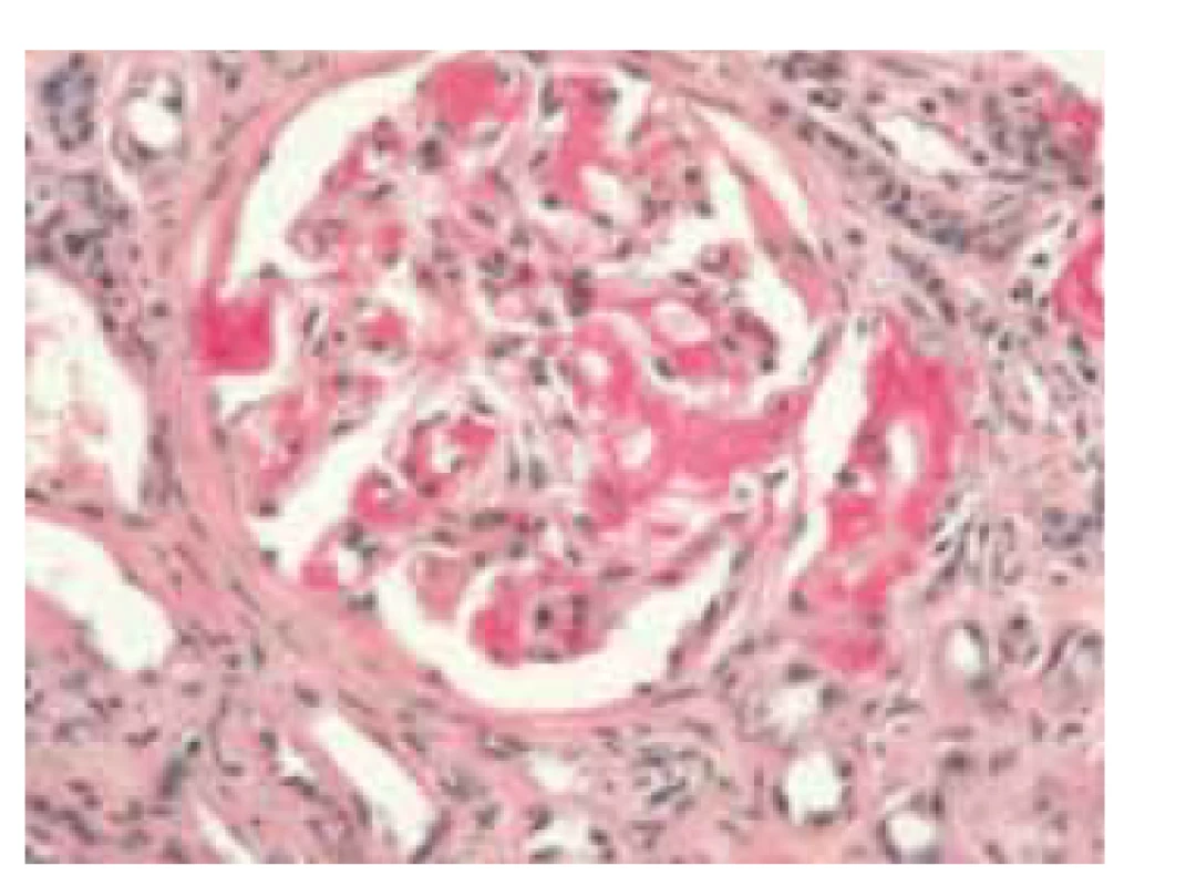 Histologický obraz glomerulu
ledviny, pozitivní amyloid sytě červený
(barvení saturnovou červení).<br>
Fig. 4. Histological image of a renal glomerulus,
positive amyloid is deep red
(saturn red staining).