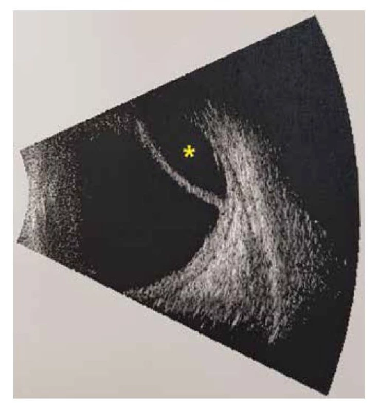 Ultrazvukový B scan levého oka, ablace choroidey
(hvězdička)