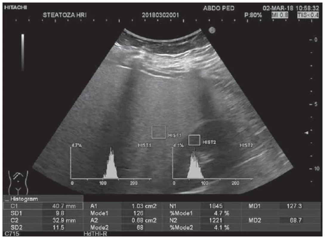Ultrasound evaluation of liver steatosis – healthy non-obese paediatric patient;
HRI = 1.85. <br> 
Obr. 2. Ultrazvukové vyšetrenie steatózy pečene – zdravý neobézny detský pacient;
HRI = 1,85.