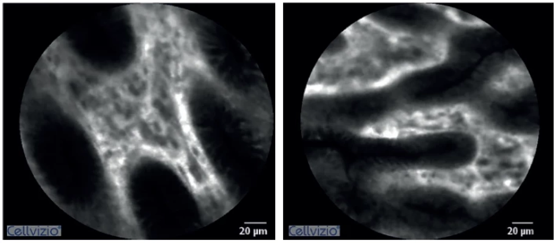 Confocal laser endomicroscopy imaging of normal colorectal anastomosis