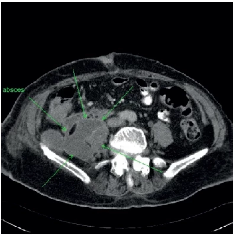 Ohraničenie abscesu na úrovni proximálnej časti
lopaty bedrovej kosti <br> 
Fig. 2. Abstraction of the abscess at the level of the proximal
part of the lumbar bone