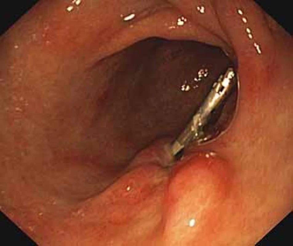 Kontrolní gastroskopické vyšetření
– nekrvácející žaludeční vřed
se správně aplikovaným hemoklipem.<br>
Fig. 2. Control gastroscopic examination
– non-bleeding gastric ulcer with
correctly applied haemoclip.