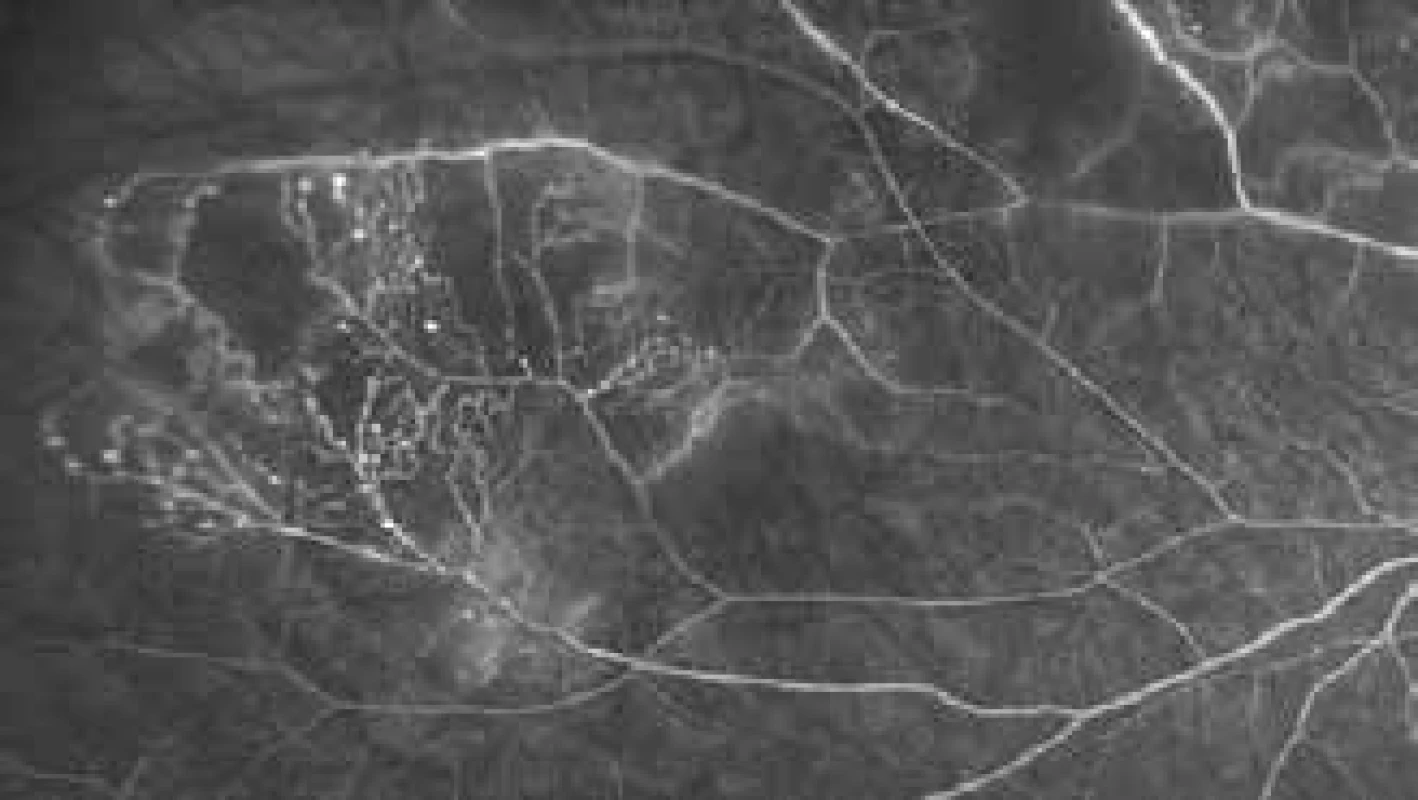 Post-radiation vascular changes – microaneurysms and
arteriovenous shunts