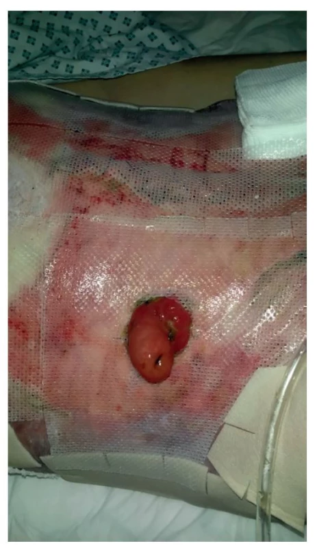 Ošetřování břišní stěny<br>
Fig. 3: Abdominal wall treatment