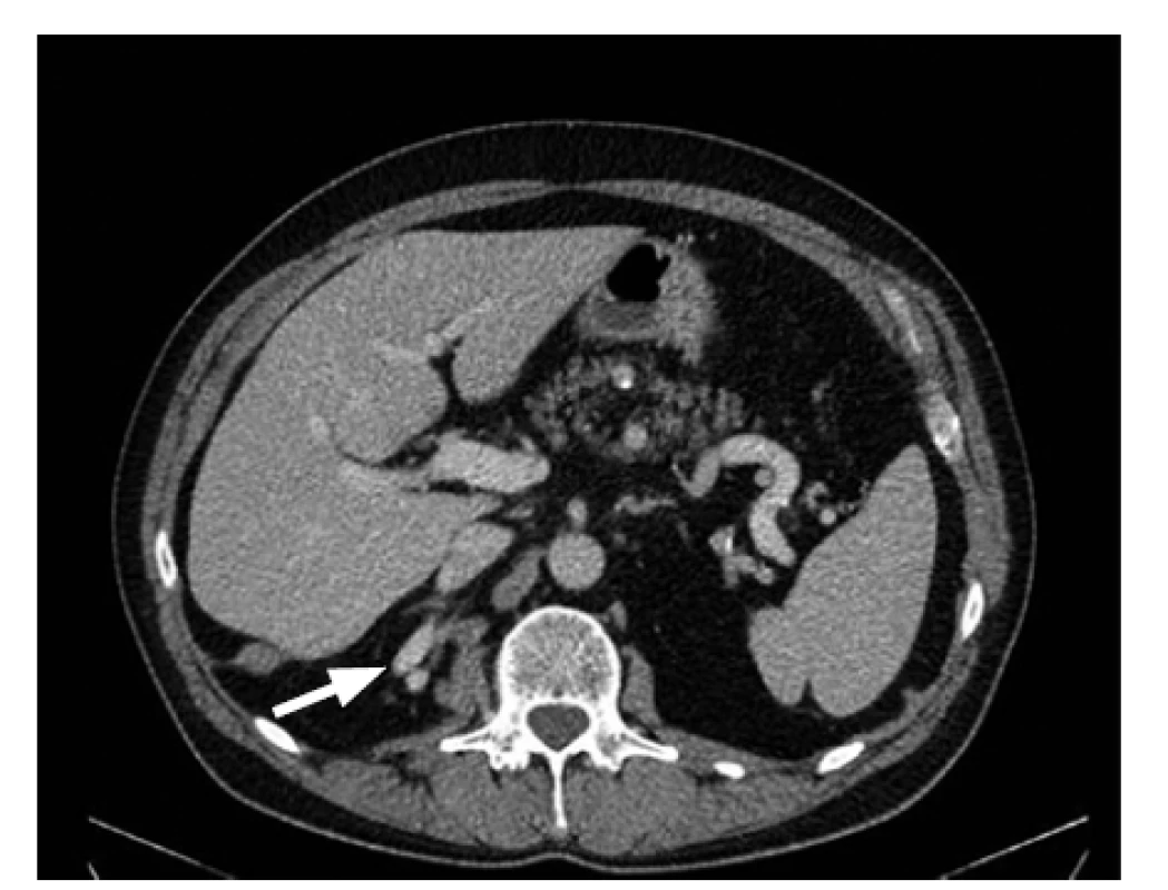 Transverzální řez; šipka ukazuje renální cévy
vstupující přes branku<br>
Fig. 4. Transverse section; the arrow shows artery
entering through hole