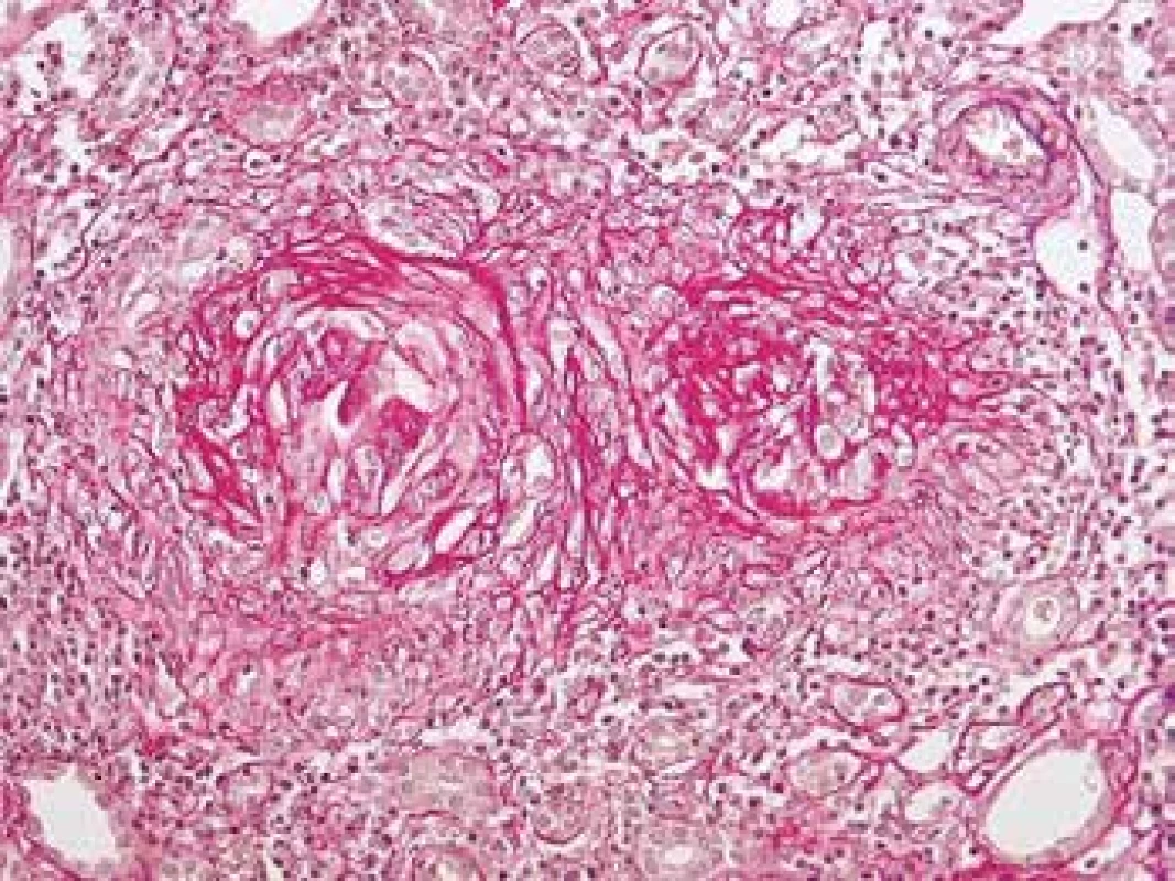 Rezidua po proběhlé atace vaskulitidy s granulomatózní destrukcí Bow. pouzder. Glomeruly jsou zjizvené, zaniklé se zánětem v okolí. Takto irreversibilní poškození se vyvine během 3. týdnů (barvení Srel).
