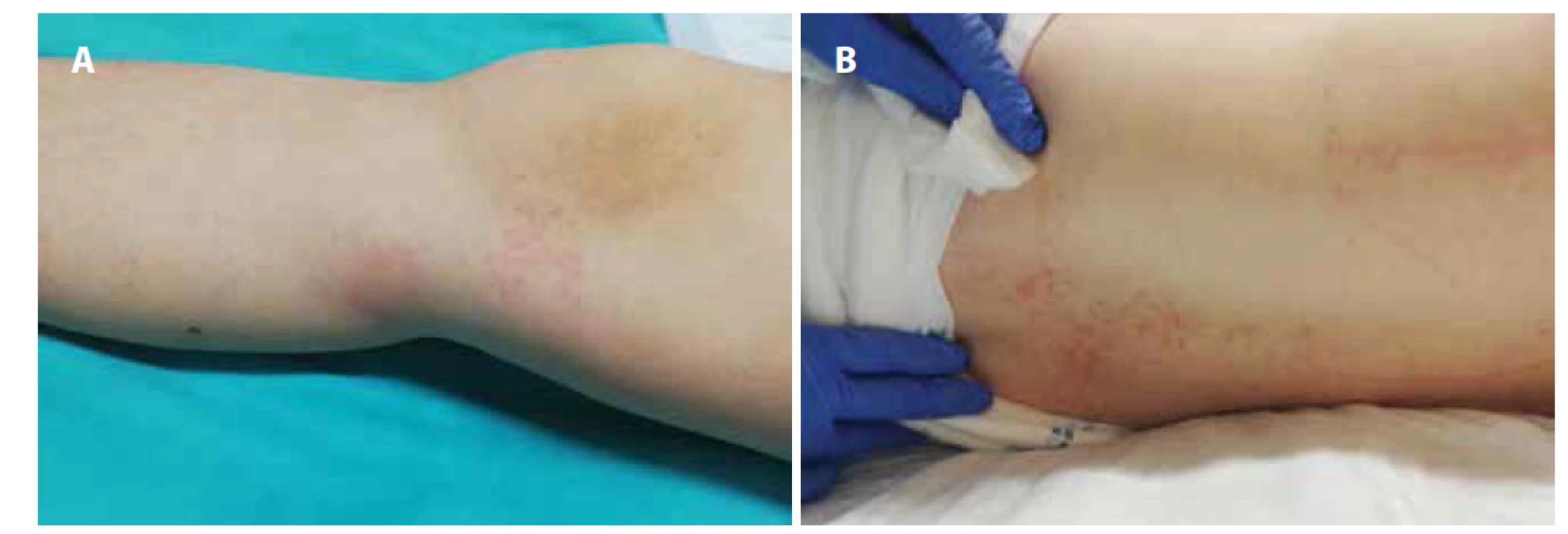A, B. Makulózny exantém na nohách (A) a chrbte (B) pacientky z klinického prípadu 2.<br>
Fig. 3A, B. Macular rash on the legs (A) and back (B) of the patient from case report 2.